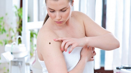 Число родинок на коже указывает на риск возникновения рака кожи